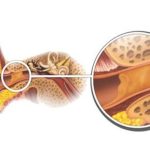 کیپ شدن و انسداد جرم گوش