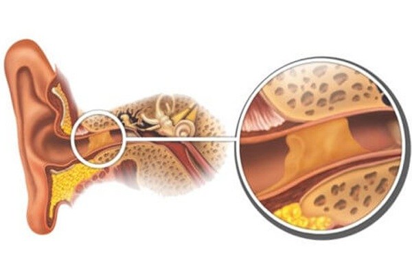 کیپ شدن و انسداد جرم گوش