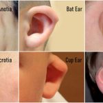 مشکلات گوش مادرزادی و درمان آن با سمعک