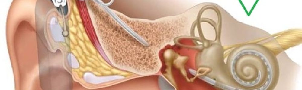 بخش-داخلی-پروتز-حلزون-گوش